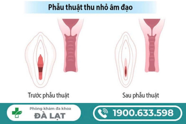 Hình ảnh minh họa
