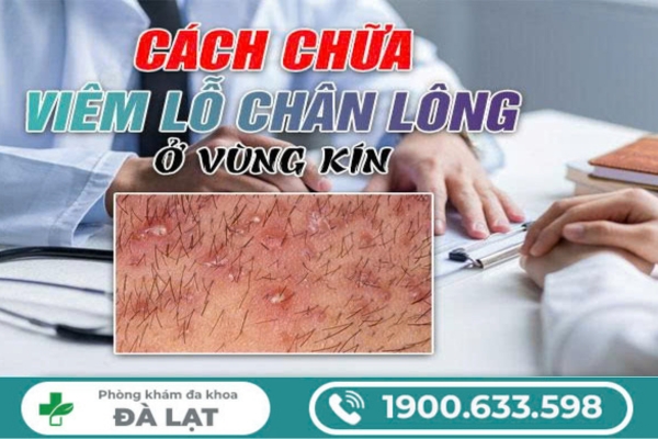 Hình ảnh minh họa